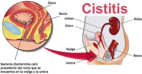Causas de infeccion de orina recurrente